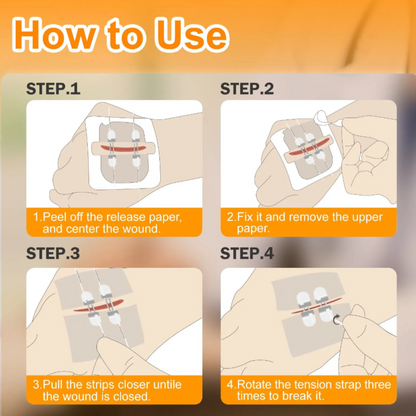 BindMD™ Wound Closure Device