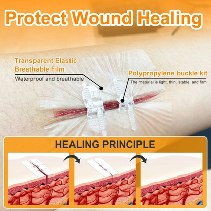 BindMD™ Wound Closure Device